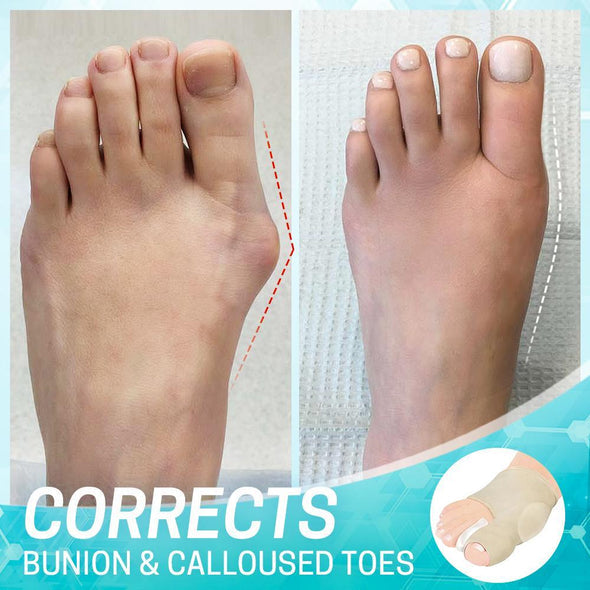 Bunion correction sleeve with gel pad | Toe aligner &amp; pressure relief | Thin, breathable &amp; wearable in shoes, 2 pairs