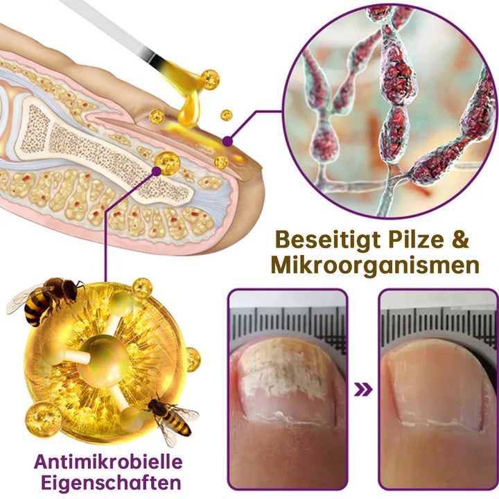 1+1 ZDARMA | PilzSchutzschild™ Odstraňuje plesne na nechtoch