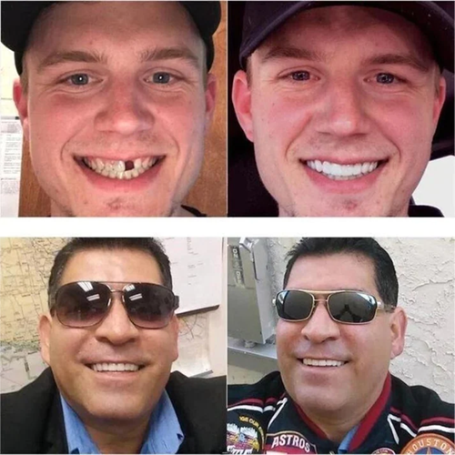 Adjustable Snap-On Tooth Cover | Flexible &amp; Comfortable for a Natural Smile | Reusable, Removable, DIY Customization