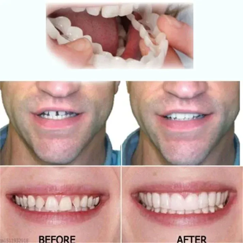 Adjustable Snap-On Tooth Cover | Flexible &amp; Comfortable for a Natural Smile | Reusable, Removable, DIY Customization