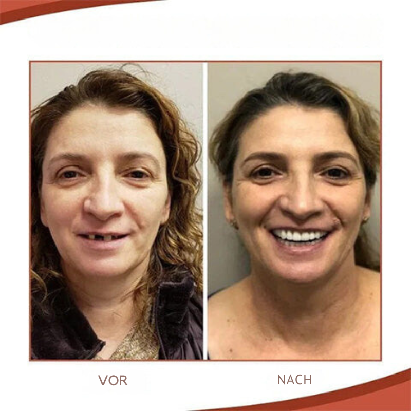 Prosthesis fitting kit with biocompatible silicone | Better fit &amp; more hold | For full &amp; partial prostheses, upper &amp; lower jaw