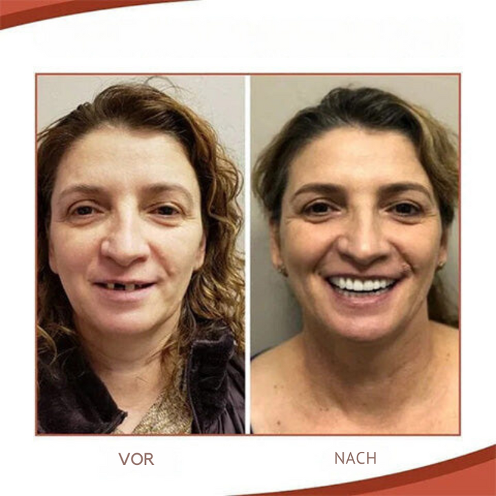 Prosthesis fitting kit with biocompatible silicone | Better fit &amp; more hold | For full &amp; partial prostheses, upper &amp; lower jaw