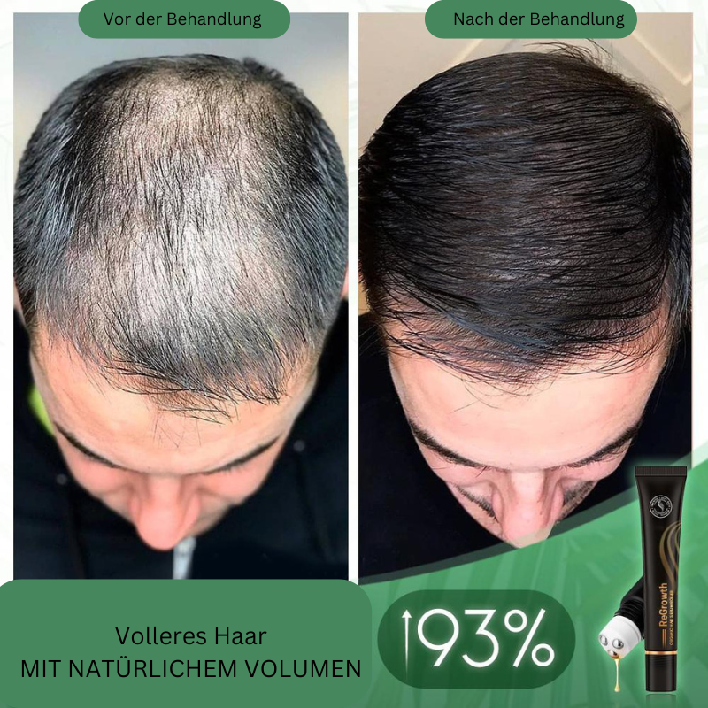 Organic Hair Serum Roller for Scalp | With Herbal Extracts, Non-Greasy | Easy to Apply &amp; Massage In | 20 ml (1+1 Set)