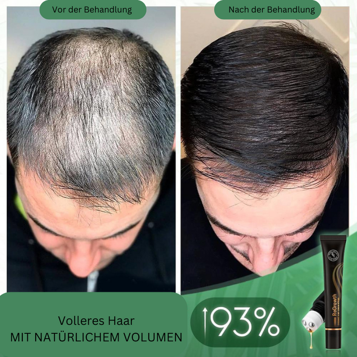 Organic Hair Serum Roller for Scalp | With Herbal Extracts, Non-Greasy | Easy to Apply &amp; Massage In | 20 ml (1+1 Set)