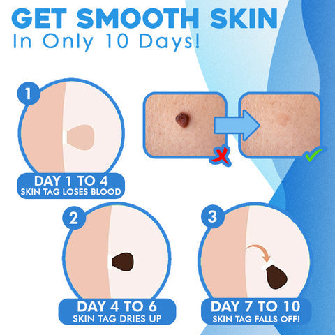 WartCleaner™ | Skincare set for removing skin impurities &amp; warts | Gentle &amp; easy