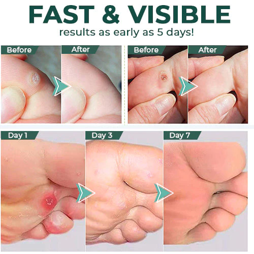 1+1 Free | SmoothFeet™ Softens hard skin