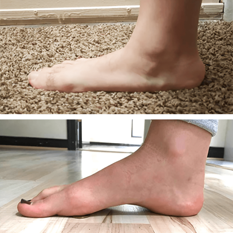 1+1 ZDARMA| SchmerzPflaster™ okamžitá úľava pre nohy